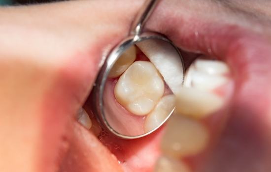 Close up of dental mirror in mouth