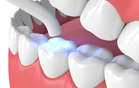 Animated amalgam free filling being treated with curing light