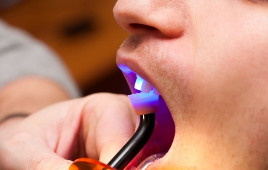 Close up of dental patient getting cosmetic dental bonding
