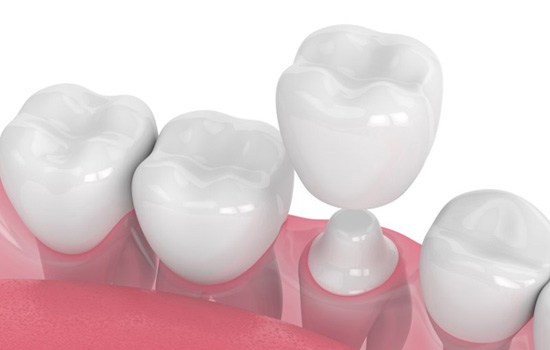 a 3 D illustration of a dental crown