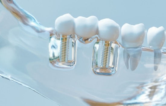Two dental implants in model of mouth