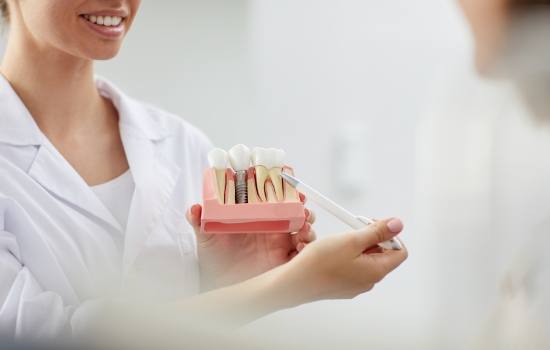 Dentist showing a patient a model of how dental implants work