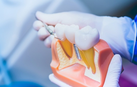 Dentist holding a model of a dental implant