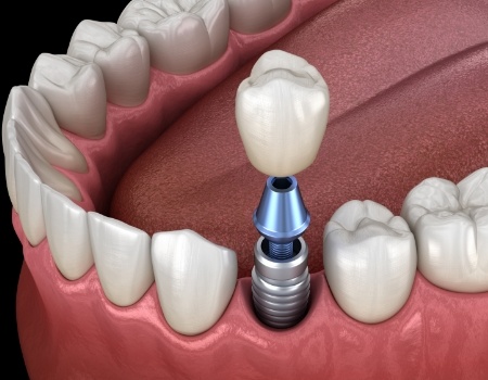 Animated dental implant with dental crown