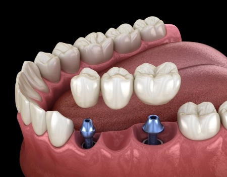 Two animated dental implants with dental bridge