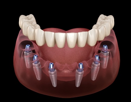 Six dental implants with full implant denture