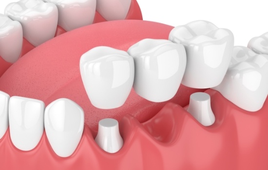 Animated dental bridge replacing a missing tooth