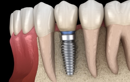 Animated dental implant with dental crown replacing a missing tooth