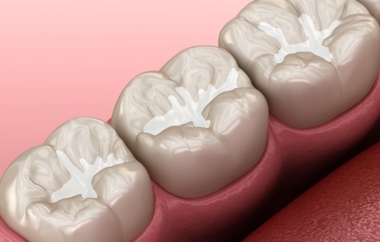 Animated row of teeth with dental sealants