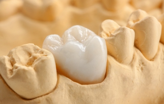 Dental crown over a tooth in model of mouth