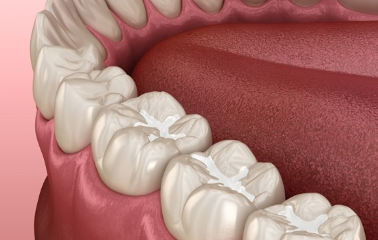 Animated row of teeth with amalgam free dental fillings