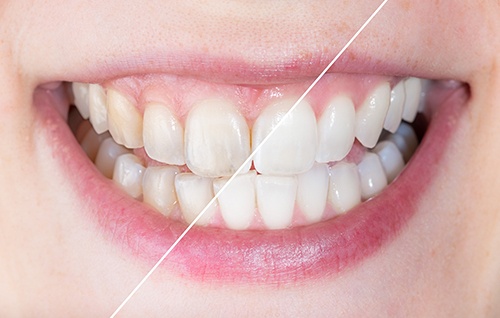 Side-by-side image of stained and whiter teeth