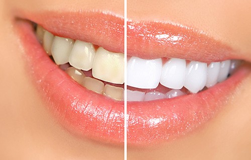 Factors that affect the cost of teeth whitening include the types of stains in your smile